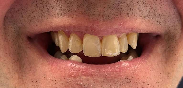 Ceramic-Bridge-Before-Image